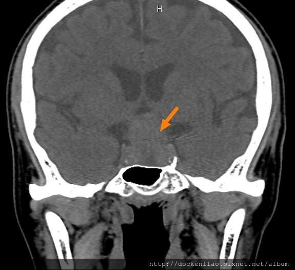 腦下垂體瘤 劉耿僚醫師 pituitary gland macroadenoma CT cor1