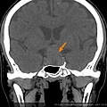 腦下垂體瘤 劉耿僚醫師 pituitary gland macroadenoma CT cor1