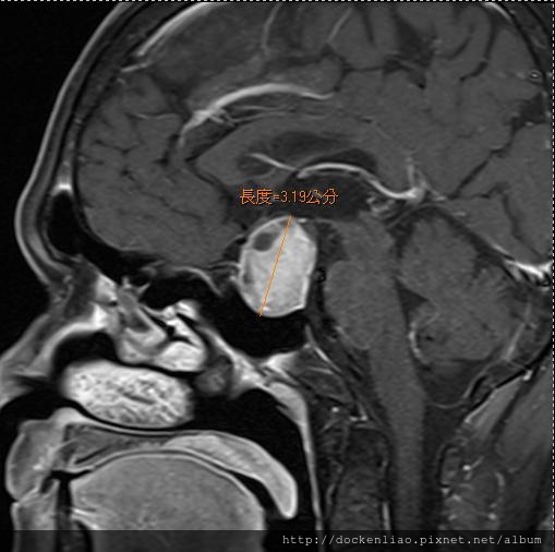 腦下垂體瘤 劉耿僚醫師 pituitary gland macroadenoma 3