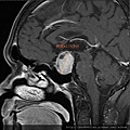 腦下垂體瘤 劉耿僚醫師 pituitary gland macroadenoma 3