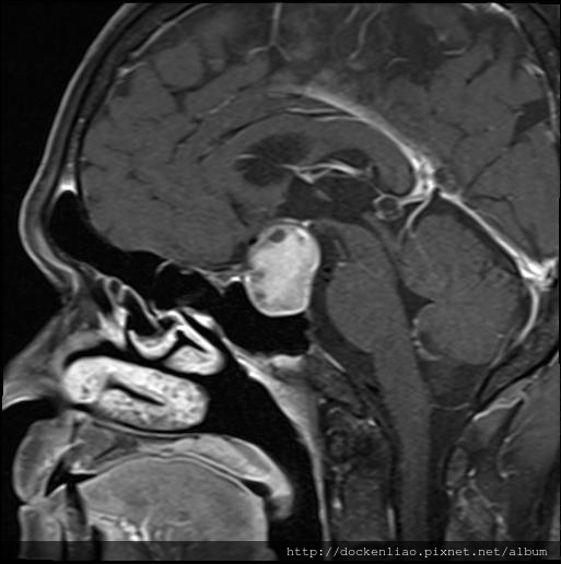 腦下垂體瘤 劉耿僚醫師 pituitary gland macroadenoma MRI sag2