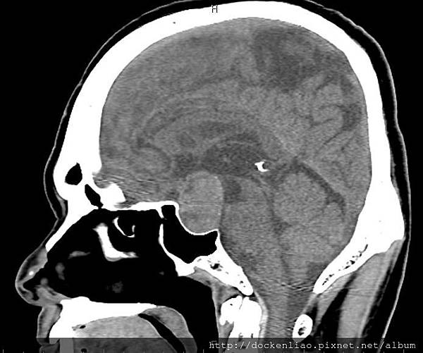 腦下垂體瘤 劉耿僚醫師 pituitary gland macroadenoma CT sag2