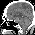 腦下垂體瘤 劉耿僚醫師 pituitary gland macroadenoma CT sag2