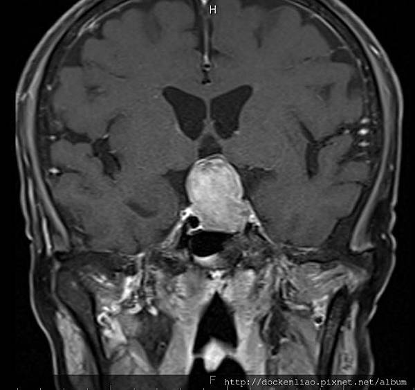 腦下垂體瘤 劉耿僚醫師 pituitary gland macroadenoma MRI cor2