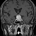 腦下垂體瘤 劉耿僚醫師 pituitary gland macroadenoma MRI cor2