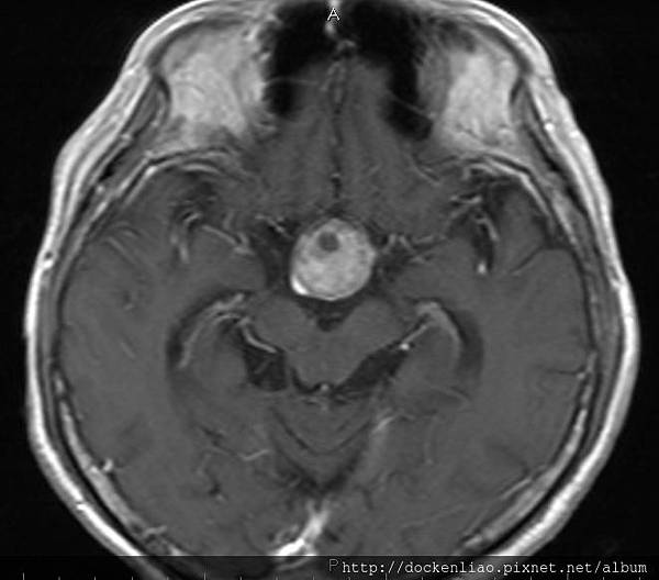 腦下垂體瘤 劉耿僚醫師 pituitary gland macroadenoma MRI axi3