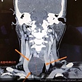 thyroid tumor cystic Dr Ken Liao Liu 甲狀腺囊狀腫瘤 劉耿僚醫師