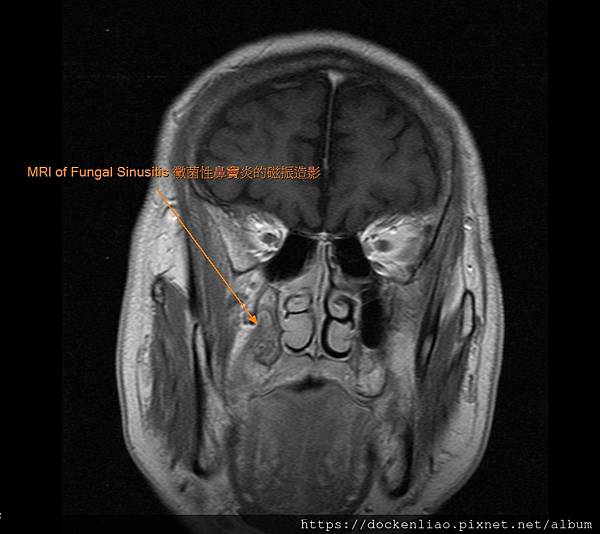 MRI of fungal sinusitis 3.jpg