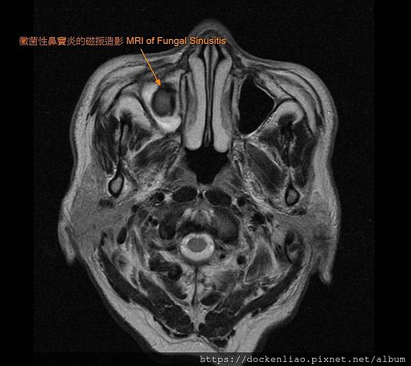 MRI of fungal sinusitis.jpg