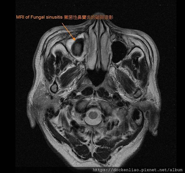 MRI of fungal sinusitis 2.jpg