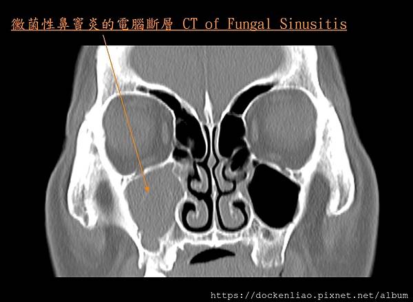 CT of fungal sinusitis.jpg