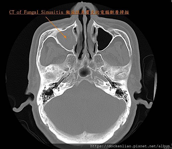 CT of fungal sinusitis 2.jpg