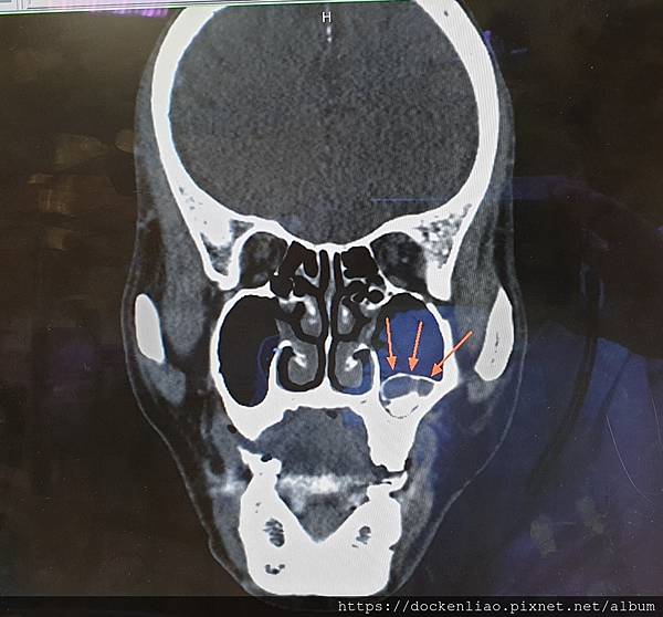 20200225_111457 fungal sinusitis calcification CT (2).jpg