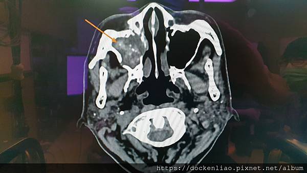 fungal sinusitis CT