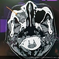 fungal sinusitis CT