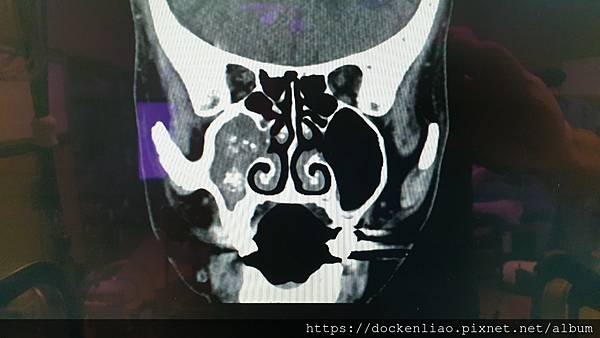 fungal sinusitis