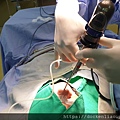 內視鏡耳咽管氣球擴張術 endoscopic E tube balloon tuboplasty