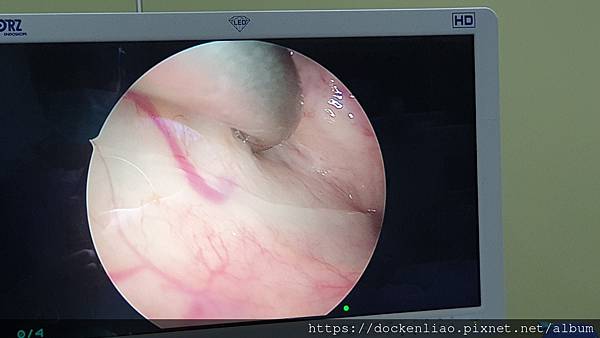 內視鏡耳咽管氣球擴張術 endoscopic E tube balloon tuboplasty