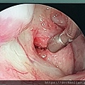 內視鏡耳咽管氣球擴張術 endoscopic E tube balloon tuboplasty