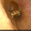 耳朵裡的蟑螂 cockroach in ear canal ear foreign body