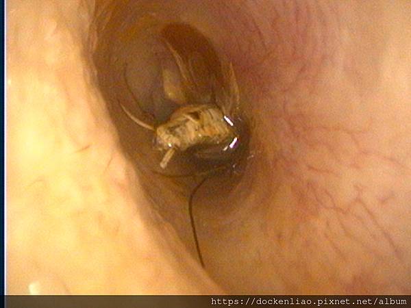 耳朵裡的蟑螂 cockroach in ear canal ear foreign body