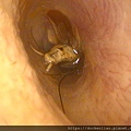 耳朵裡的蟑螂 cockroach in ear canal ear foreign body