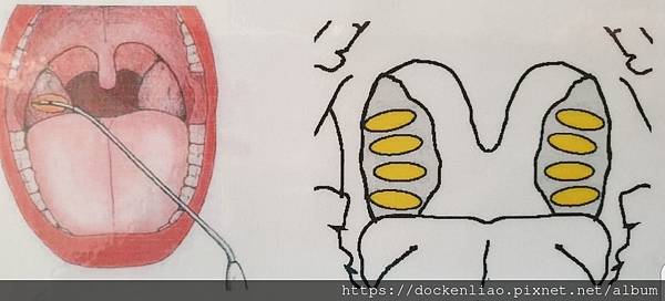 打鼾 打呼 睡眠呼吸中止症 劉耿僚醫師 snoring OSAS