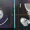 小兒唾液腺膿瘍 pediatric salivary abscess