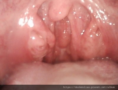 扁桃腺肥大 tonsil hypertrophy