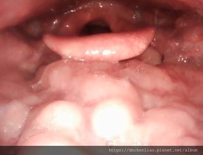 舌扁桃肥大 lingual tonsil hypertrophy