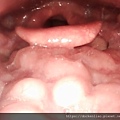 舌扁桃肥大 lingual tonsil hypertrophy