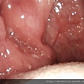 2021-08-04 013 tonsil fossa tonsil pus thrombi.jpg