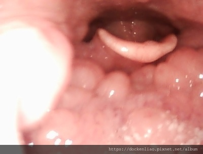 扁桃腺肥大 tonsil hypertrophy