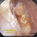 外耳道黴菌感染 otomycosis 劉耿僚醫師