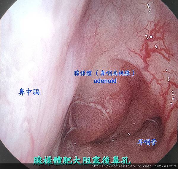 腺樣體阻塞後鼻孔 劉耿僚醫師