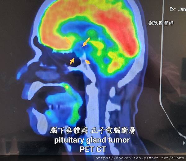 腦下垂體瘤 劉耿僚醫師 pituitary gland tumor