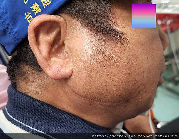 腮腺腫瘤 劉耿僚醫師 parotid tumor