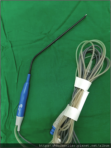 Laryngeal-wand-used-for-excision-of-laryngeal-papilloma-in-coblation-technique.ppm