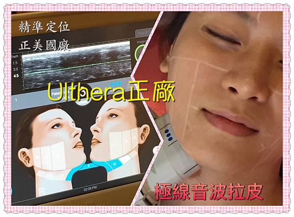 ULTHERA ULTHERA