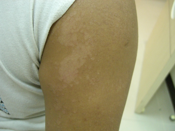 SKIN DISEASE SKIN DISEASE