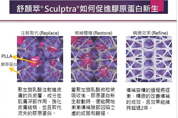 sculptra 增生模型.jpg