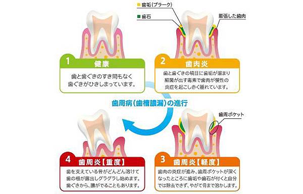 牙周病