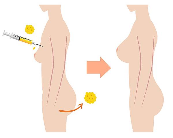 自體脂肪隆乳,隆乳,博恩妍