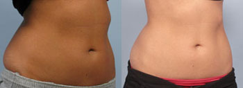 Coolsculpting-q8.jpg