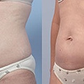 Coolsculpting-q18.jpg