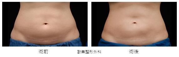 Coolsculpting-q3.jpg