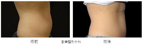 Coolsculpting-q4.jpg