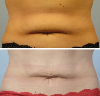 Coolsculpting-q10.jpg