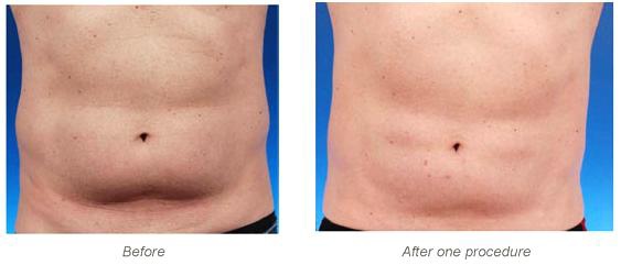 Coolsculpting-q11.jpg