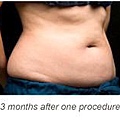 Coolsculpting-q12.jpg